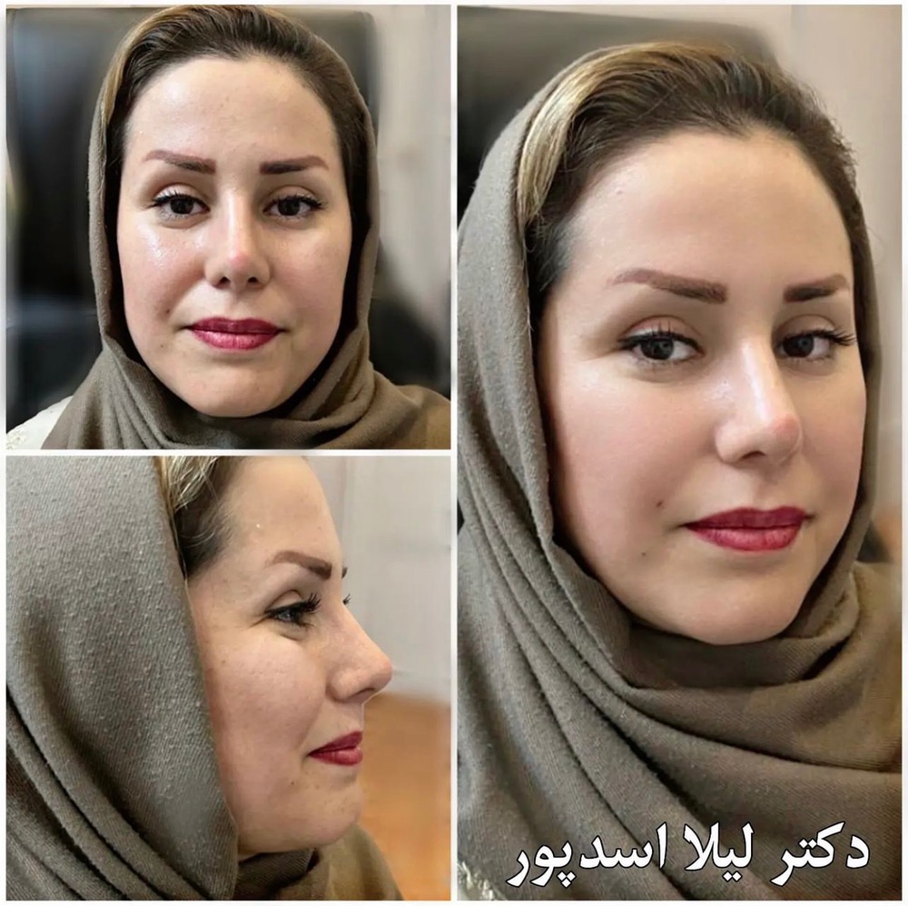 نمونه عمل بینی جراح شیراز