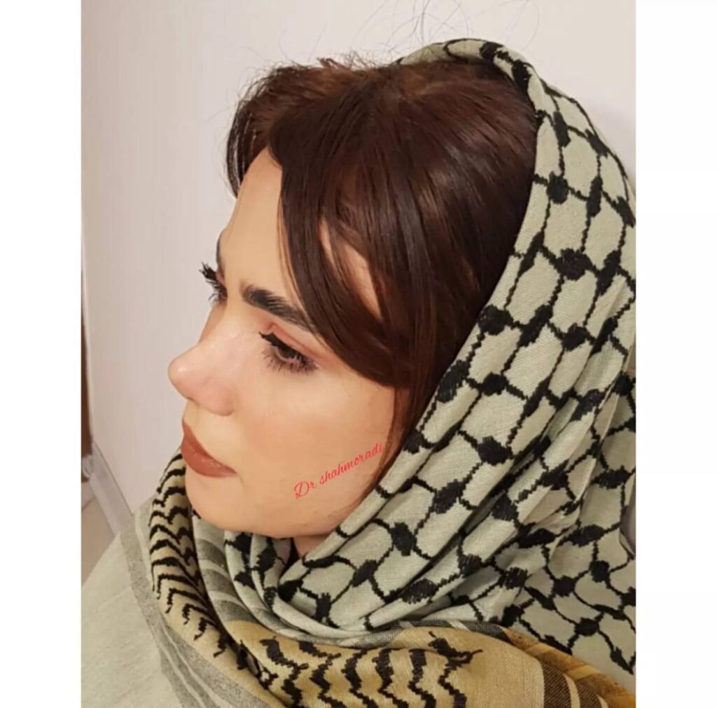 نمونه عمل بینی دکتر شهریار شاهمرادی در شیراز؛ مجموعه ی زیباکس