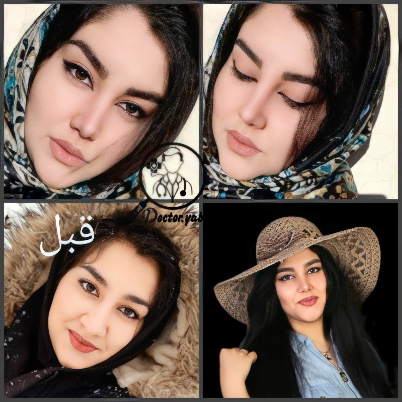 بهترین جراح بینی شیراز؛ نمونه عمل بینی گوشتی با زیباکس