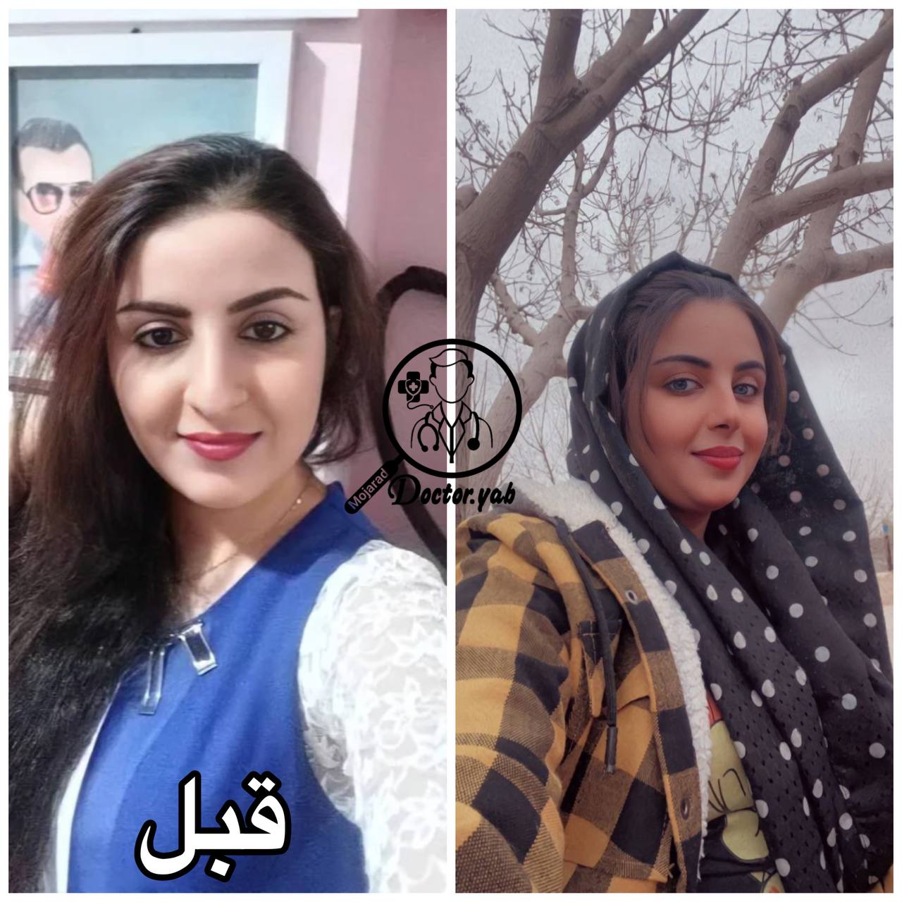 بهترین جراح بینی شیراز؛ عمل بینی سبک طبیعی زیباکس