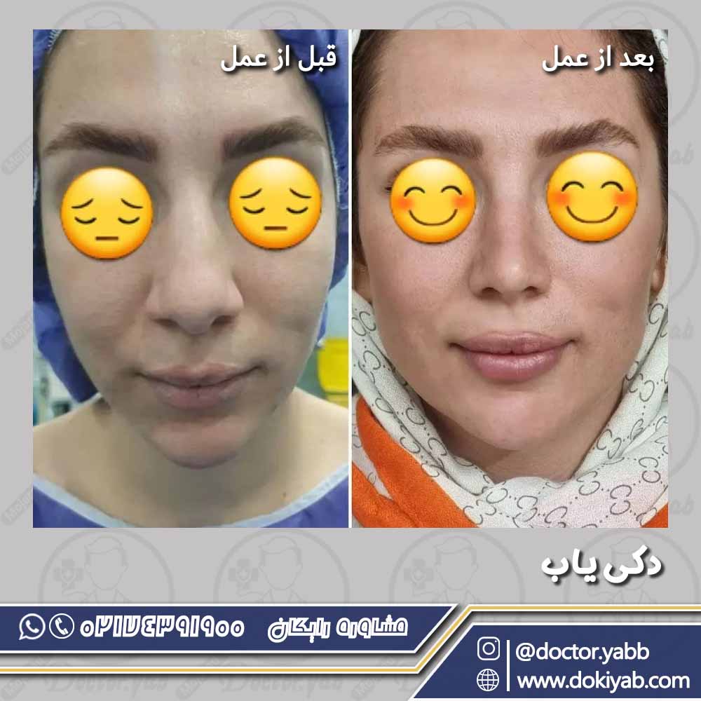 جراحی بینی توسط دکتر حسین کرم نژاد در شیراز؛ مجموعه زیباکس