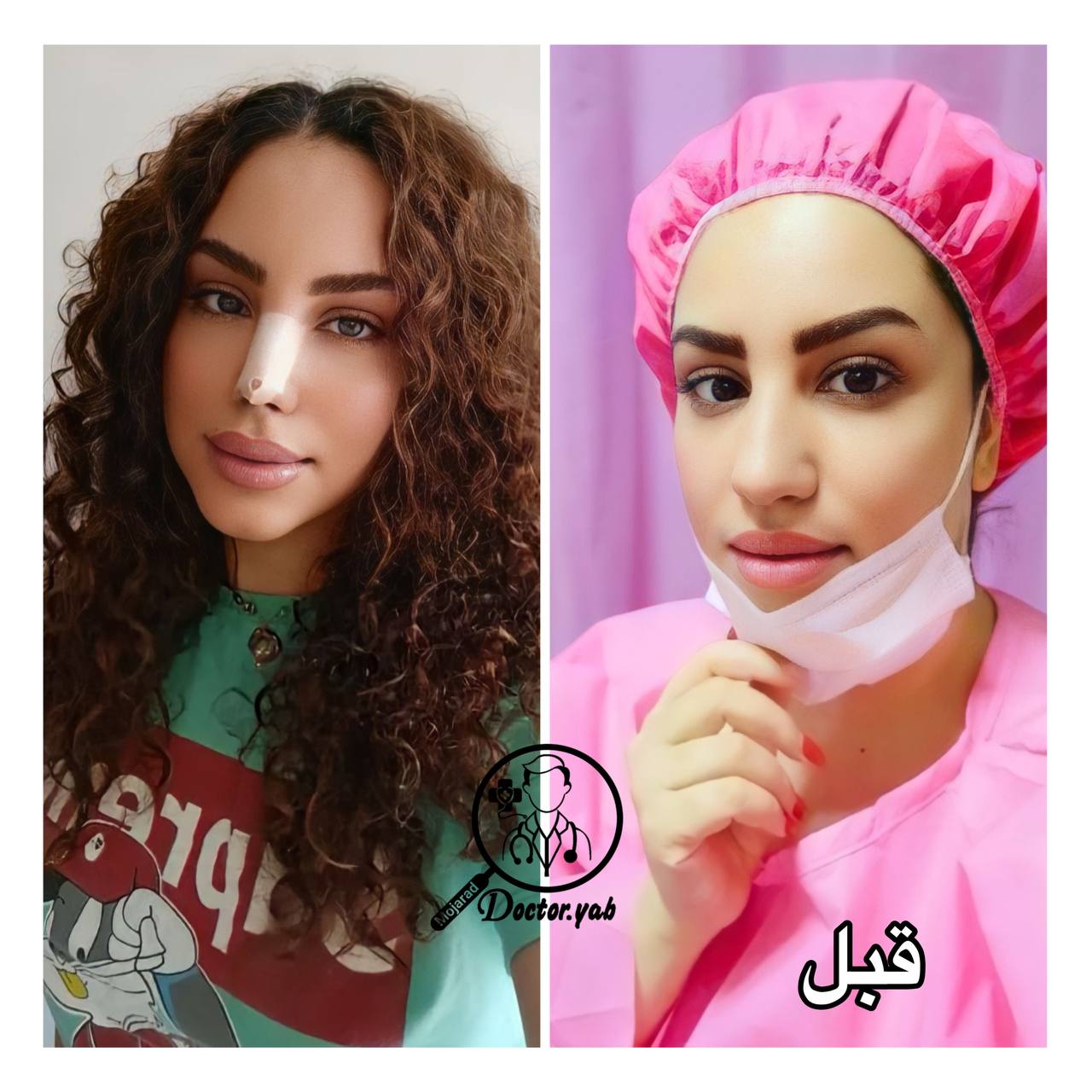 جراحی بینی گوشتی در شیراز با مجموعه ی زیباکس