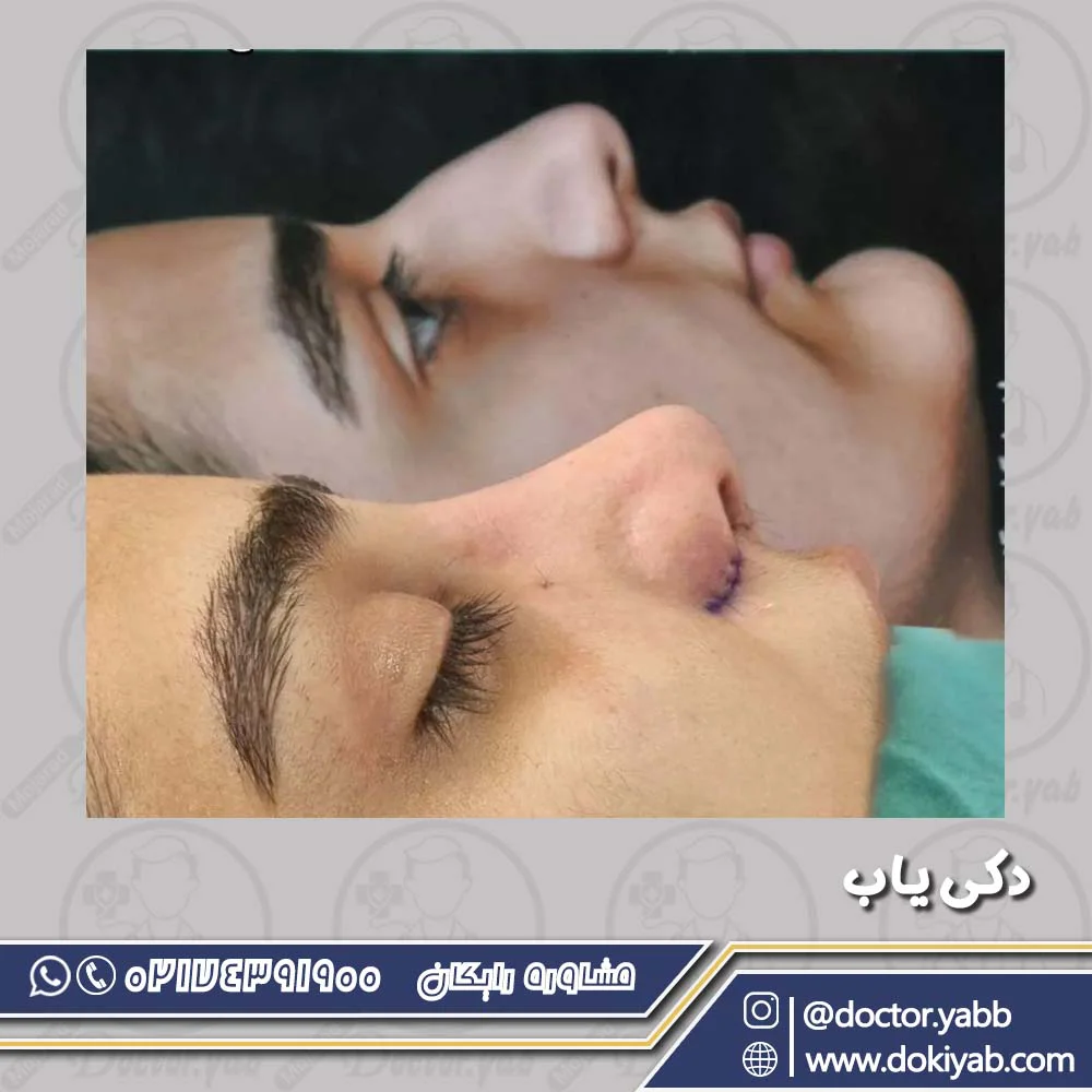 عمل جراحی بینی استخوانی در شیراز با دکتر حسین کرم نژاد