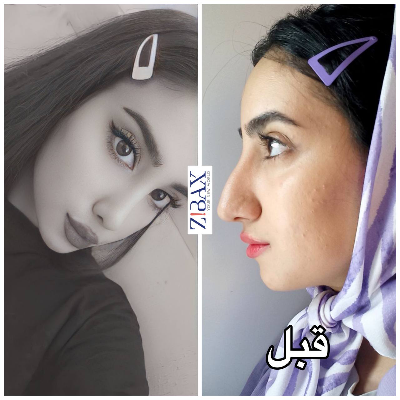 جراحی بینی استخوانی با مجموعه ی زیباکس در شیراز
