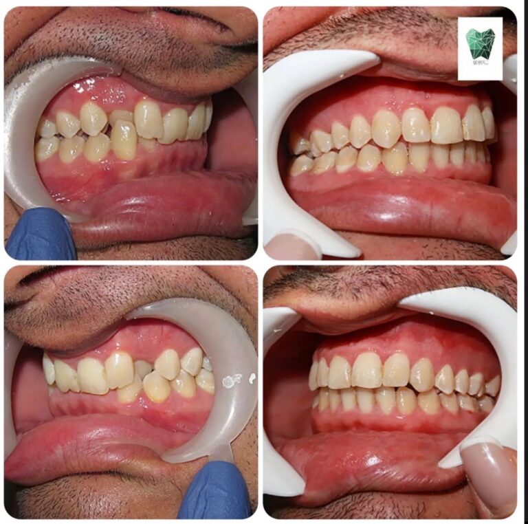 نمونه ارتودنسی دندان در شیراز