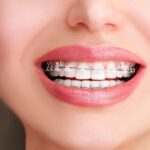 جامع‌ترین راهنمای ارتودنسی دندان