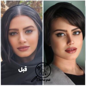 نمونه عمل بینی استخوانی در شیراز زیباکس 5