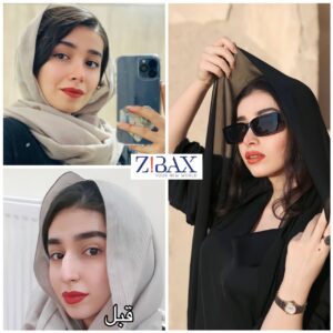 نمونه عمل بینی استخوانی در شیراز زیباکس 6