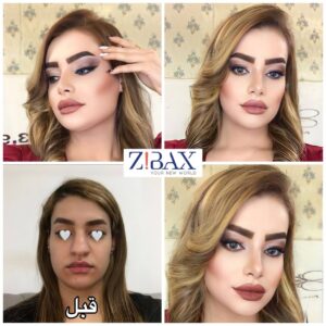 نمونه عمل بینی گوشتی در شیراز زیباکس 10