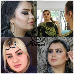 نمونه عمل بینی گوشتی در شیراز زیباکس 13