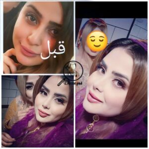 نمونه عمل بینی گوشتی در شیراز زیباکس 15