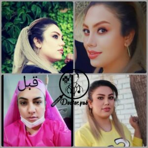 نمونه عمل بینی گوشتی در شیراز زیباکس 17