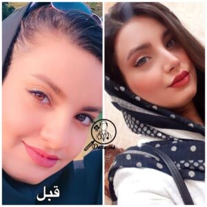 نمونه عمل بینی گوشتی در شیراز زیباکس 6