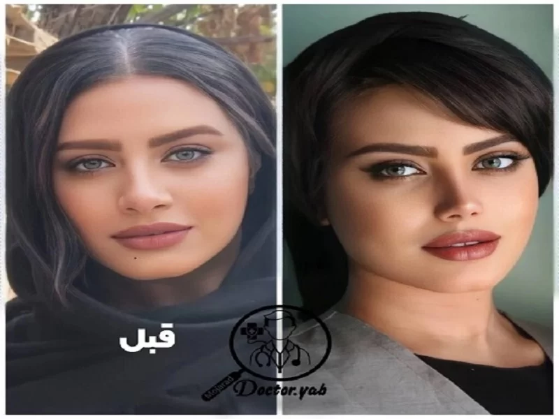 راهی به زیبایی و اعتماد به نفس با رینوپلاستی بینی