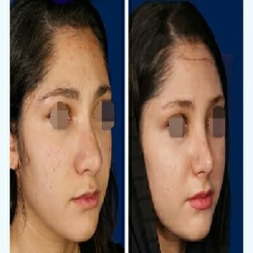 نمونه جراحی بینی دکتر روشنی با مشاوره مجموعه زیباکس