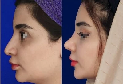 نمونه جراحی بینی دکتر روشنی با مشاوره زیباکس