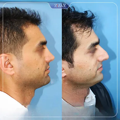 نمونه عمل جراحی بینی دکتر داریوش ساریخانی — تصویر 2