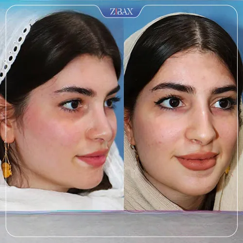 نمونه عمل جراحی بینی دکتر داریوش ساریخانی — تصویر 1