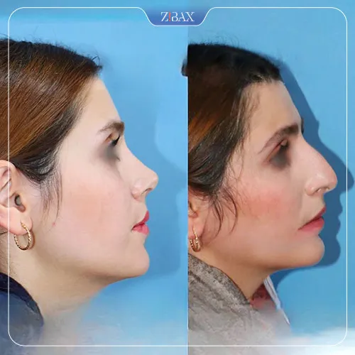 نمونه عمل جراحی بینی دکتر داریوش ساریخانی — تصویر 8