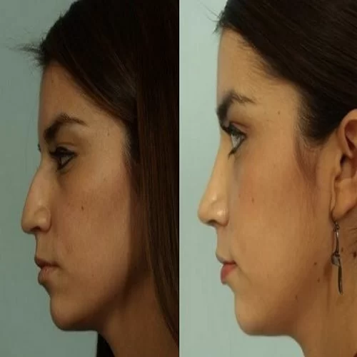 نمونه جراحی بینی دکتر شمیلا رضوانی نیا