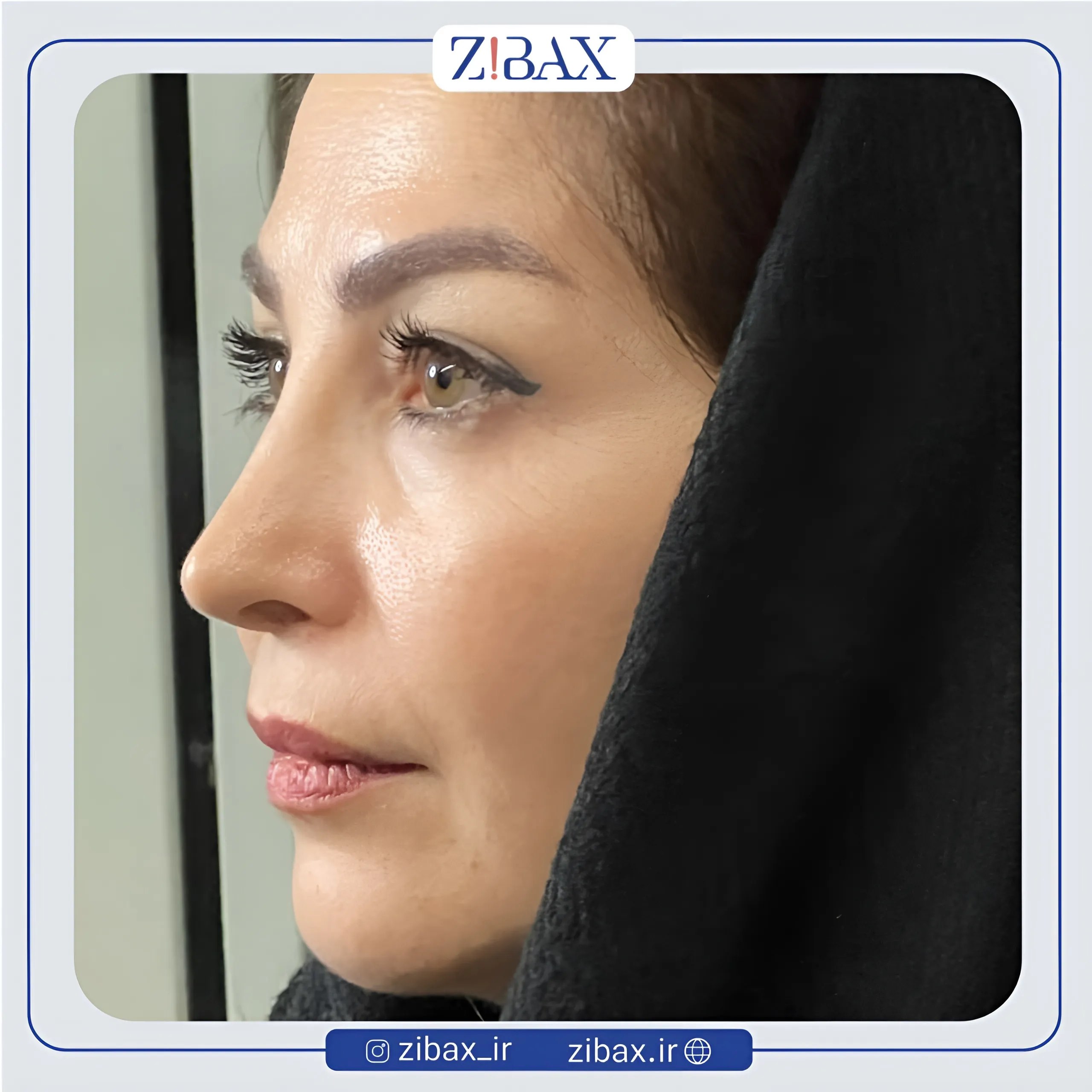 نمونه عمل جراحی بینی دکتر امیر دریانی — تصویر 9