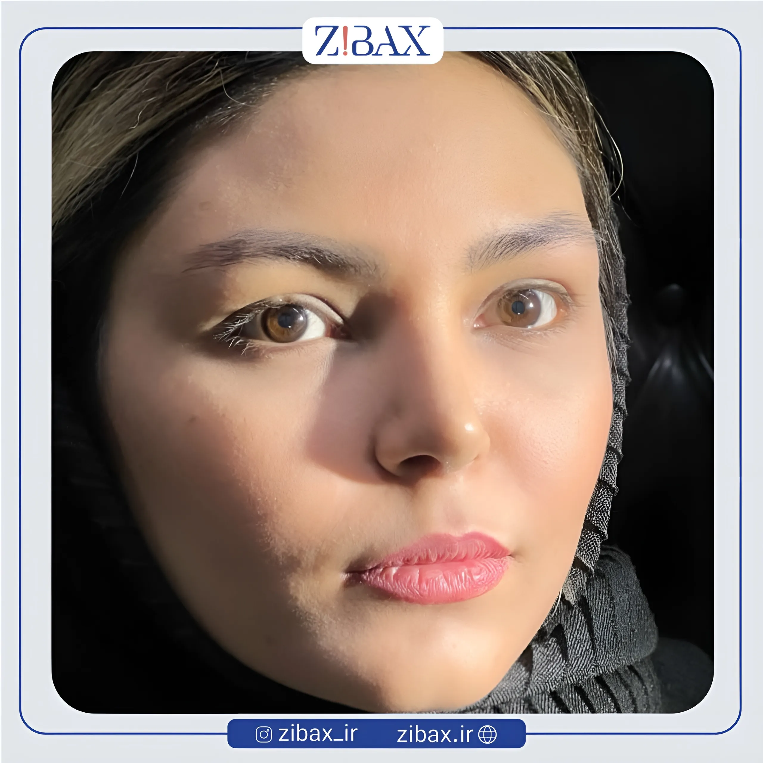 نمونه عمل جراحی بینی دکتر امیر دریانی — تصویر 2