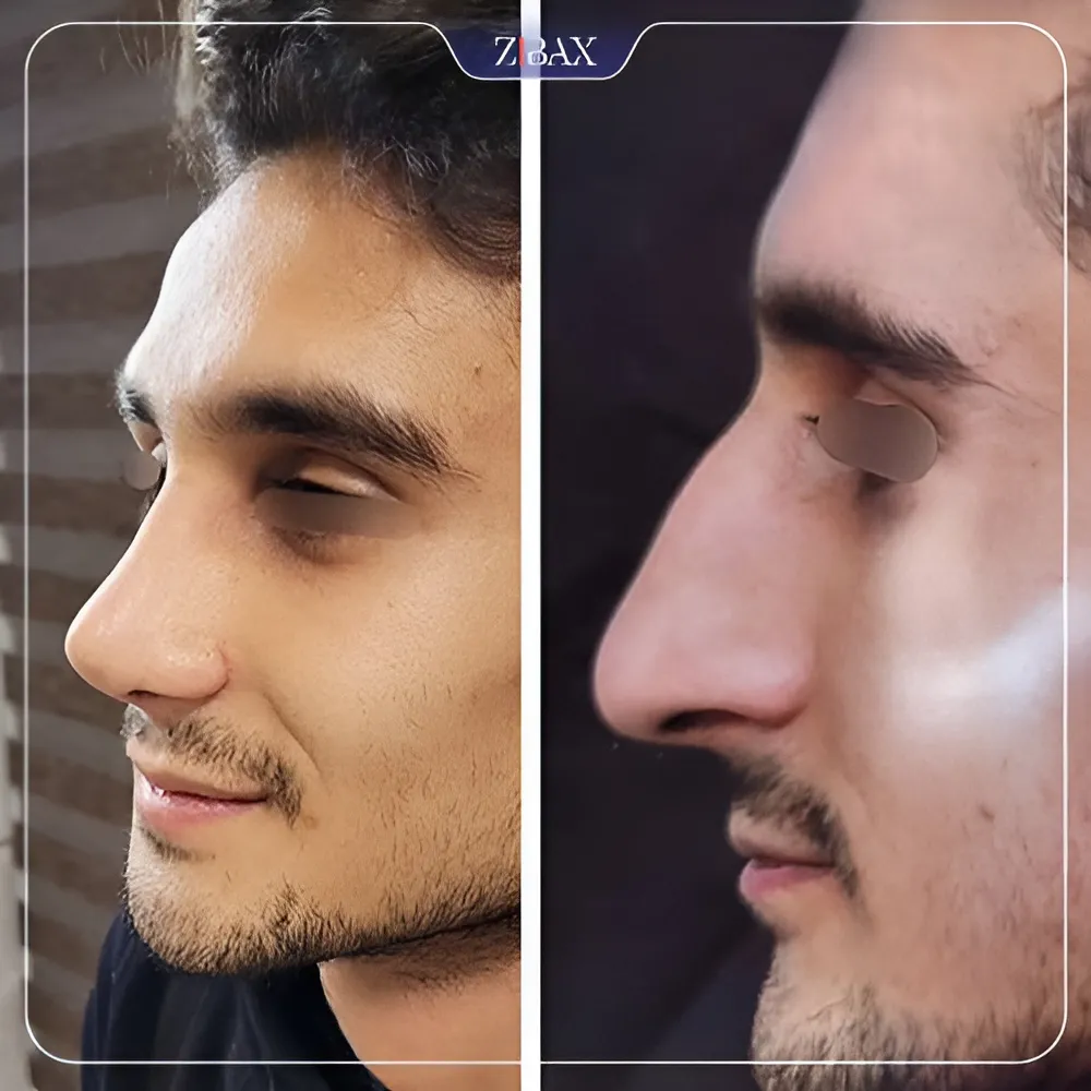 نمونه عمل جراحی بینی دکتر شمیلا رضوانی نیا — تصویر 1