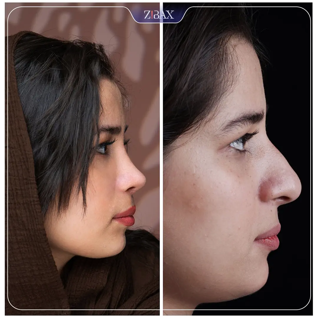 نمونه عمل جراحی بینی دکتر سولماز قربانی — تصویر 9