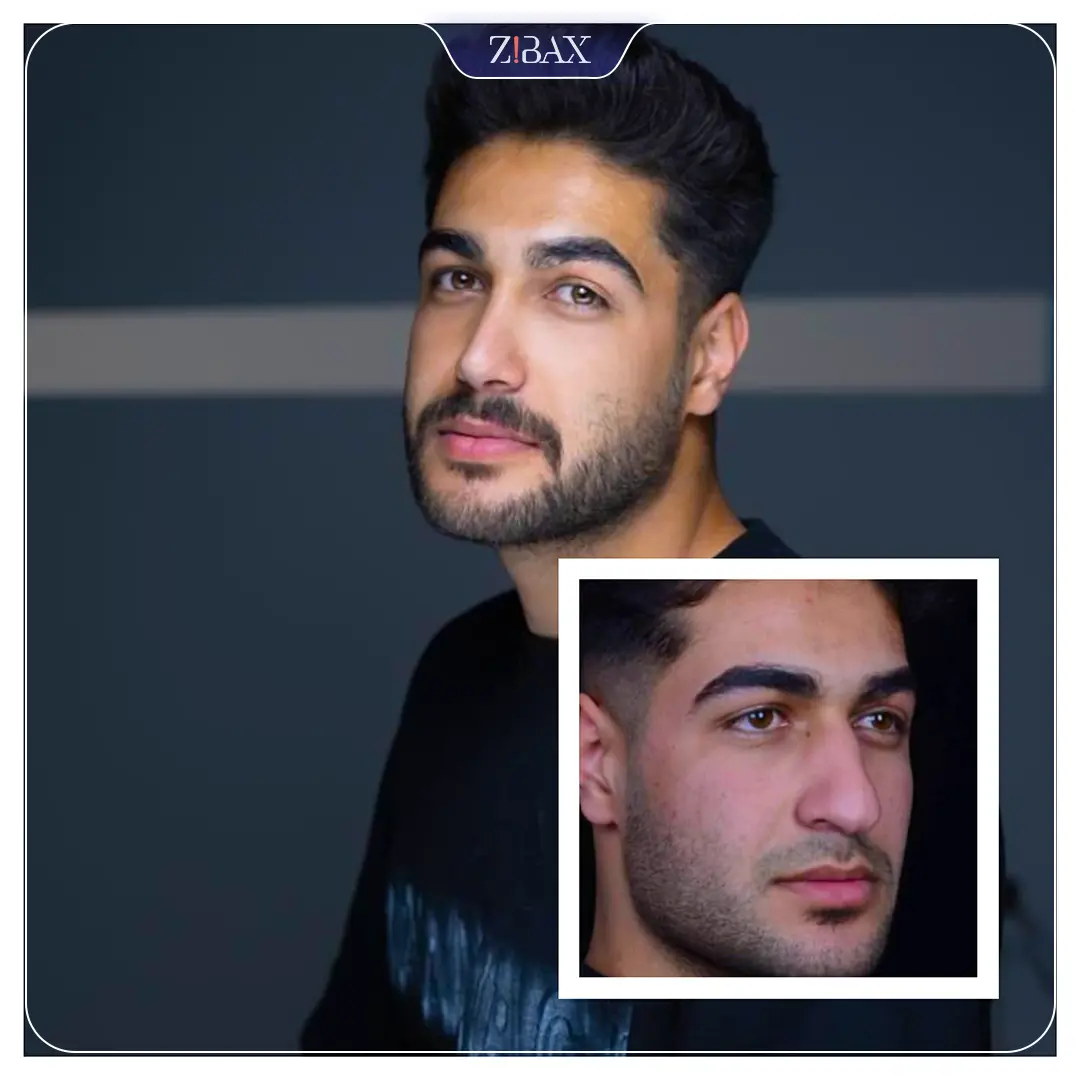 نمونه عمل جراحی بینی دکتر سولماز قربانی — تصویر 10