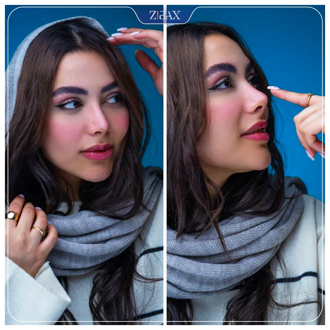 نمونه عمل جراحی بینی دکتر سولماز قربانی — تصویر 12