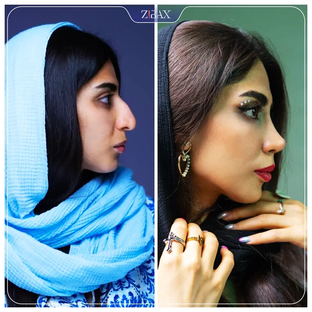 نمونه عمل جراحی بینی دکتر سولماز قربانی — تصویر 4