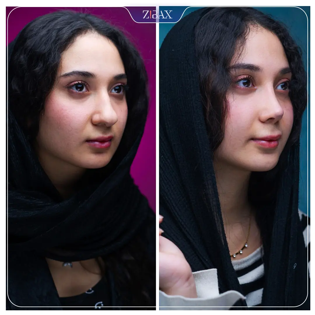 نمونه عمل جراحی بینی دکتر سولماز قربانی — تصویر 5