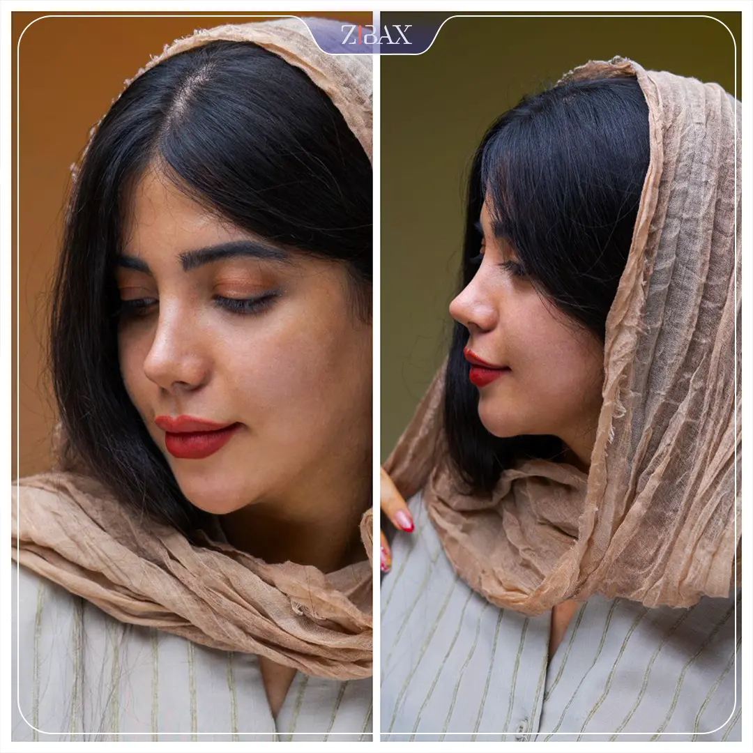 نمونه عمل جراحی بینی دکتر سولماز قربانی — تصویر 6