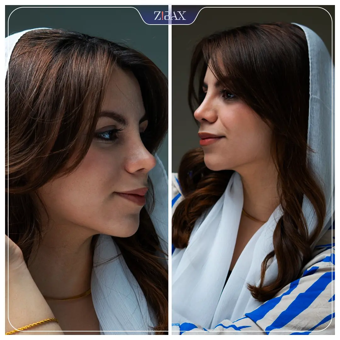نمونه عمل جراحی بینی دکتر سولماز قربانی — تصویر 7