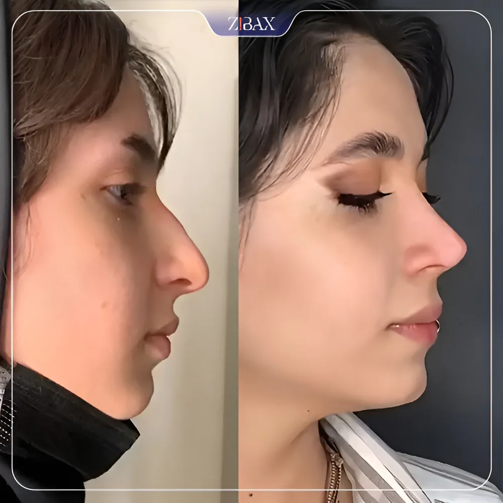نمونه عمل جراحی بینی دکتر لطفعلی نوروزی — تصویر 10