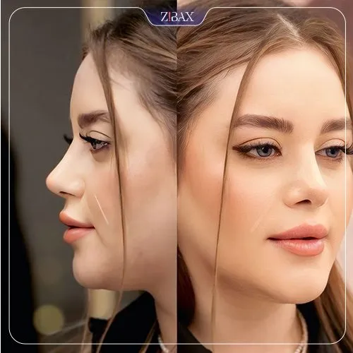 نمونه عمل جراحی بینی دکتر علیرضا محبی — تصویر 10