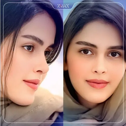 نمونه عمل جراحی بینی دکتر علیرضا محبی — تصویر 9