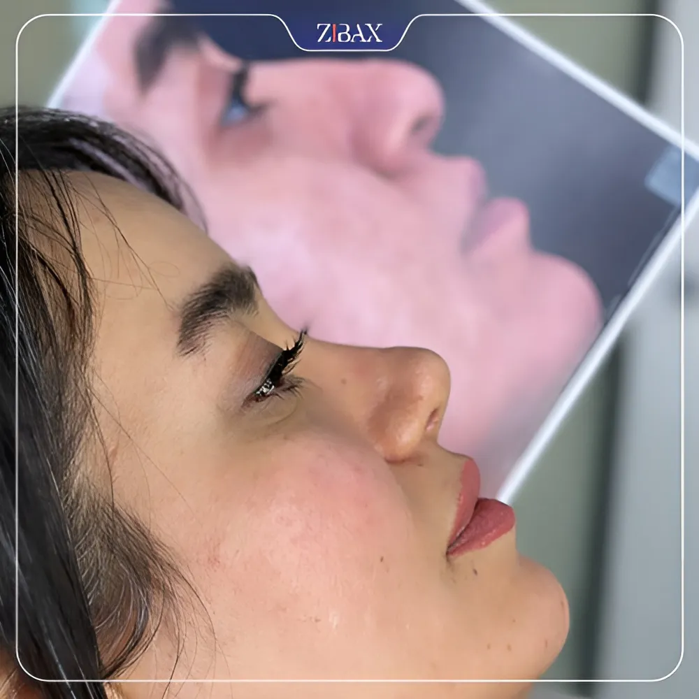 نمونه عمل جراحی بینی دکتر آمیتیس نوذری — تصویر 2