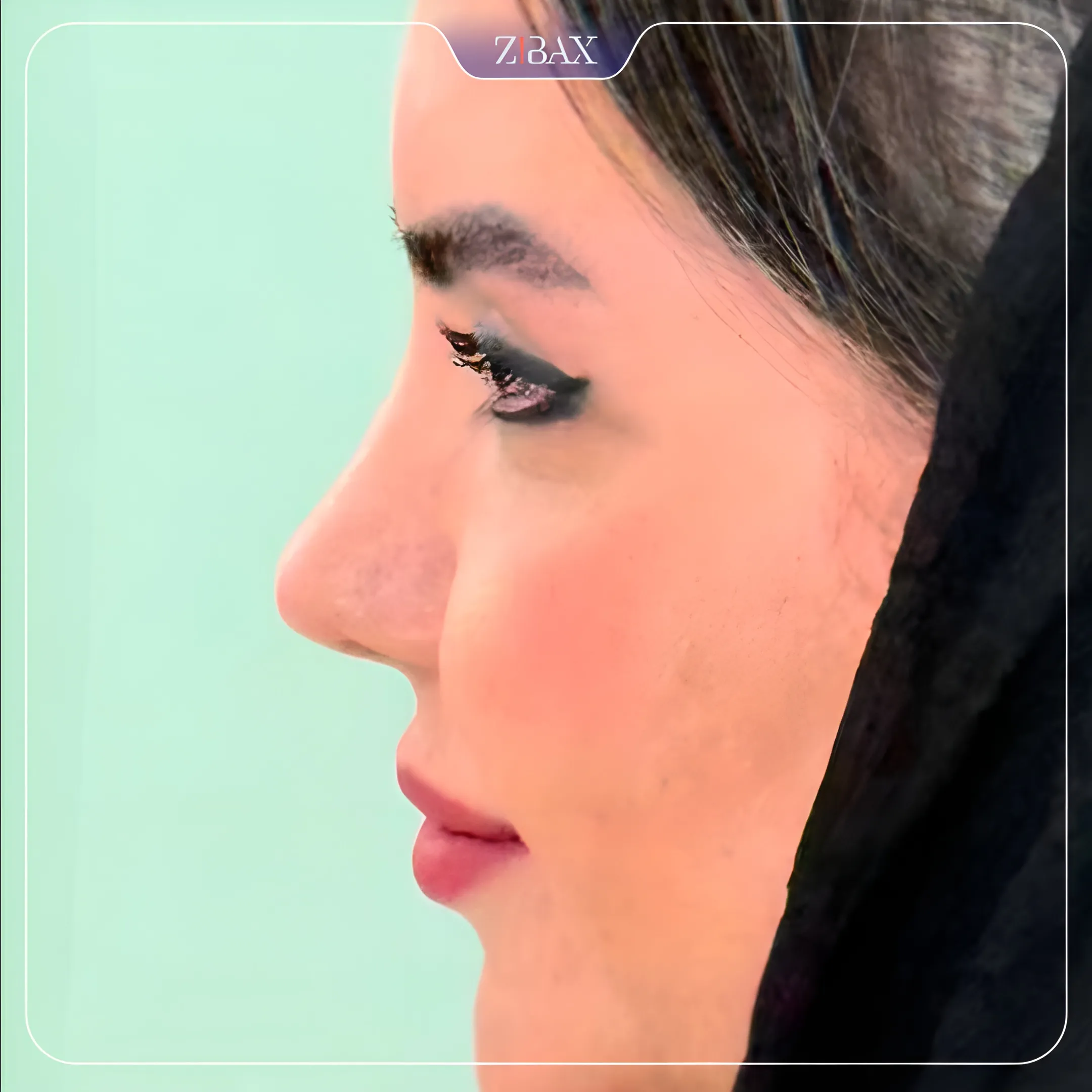 نمونه عمل جراحی بینی دکتر آمیتیس نوذری — تصویر 5