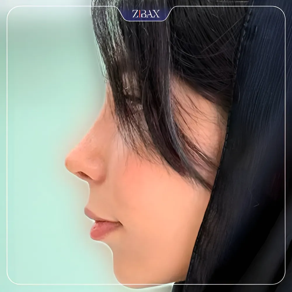 نمونه عمل جراحی بینی دکتر آمیتیس نوذری — تصویر 4