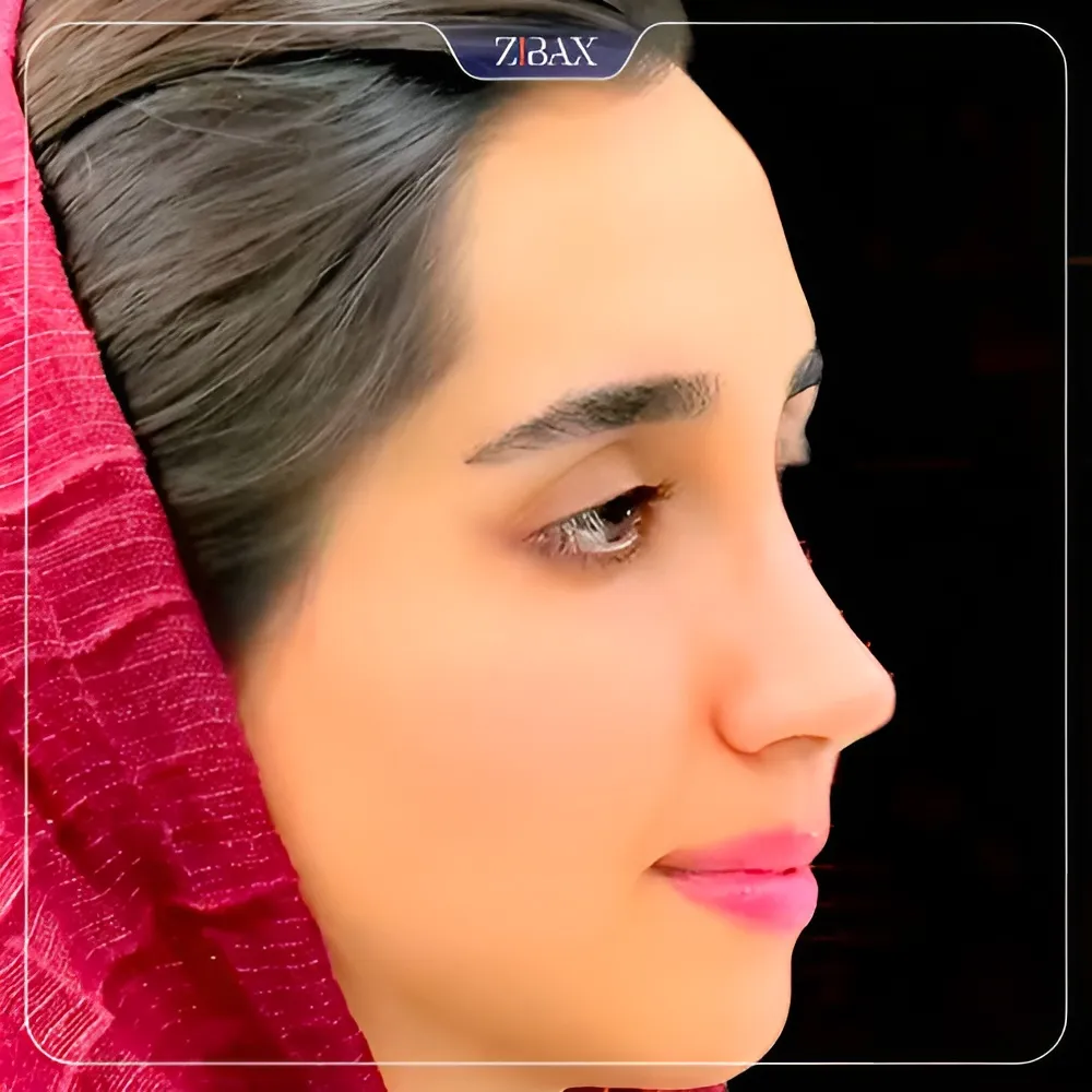 نمونه عمل جراحی بینی دکتر آمیتیس نوذری — تصویر 7