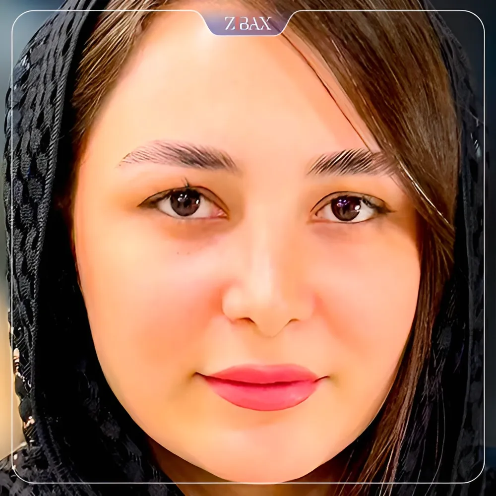 نمونه عمل جراحی بینی دکتر آمیتیس نوذری — تصویر 8