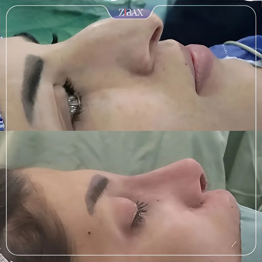 نمونه عمل جراحی بینی دکتر کاظم رشته احمدی — تصویر 6
