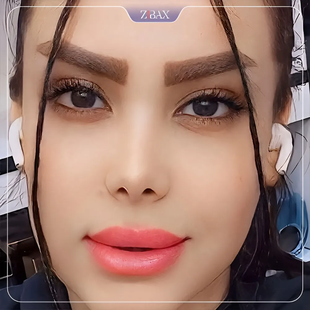 نمونه عمل جراحی بینی دکتر کاظم رشته احمدی — تصویر 3