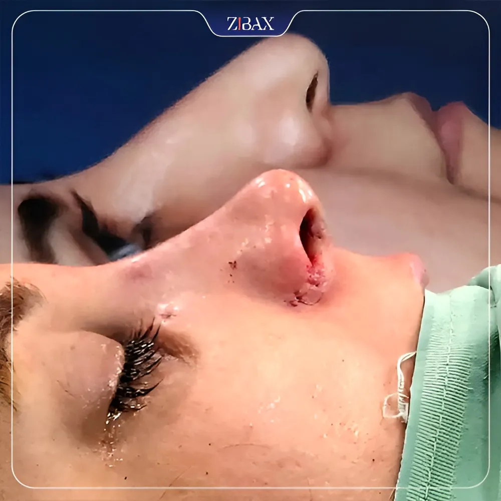 نمونه عمل جراحی بینی دکتر کاظم رشته احمدی — تصویر 1
