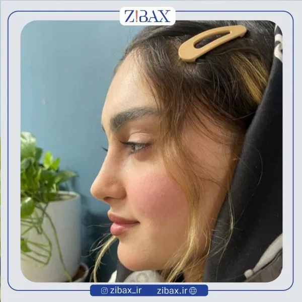 نمونه عمل جراحی بینی دکتر نگار جعفری — تصویر 1
