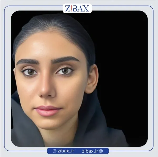 نمونه عمل جراحی بینی دکتر نگار جعفری — تصویر 6