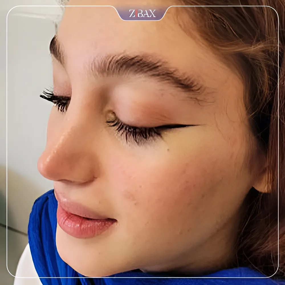 نمونه عمل جراحی بینی دکتر شمیلا رضوانی نیا — تصویر 7