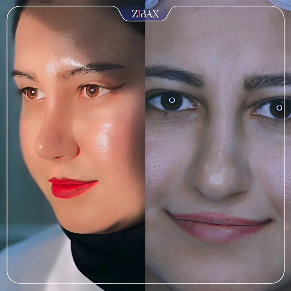 نمونه عمل جراحی بینی دکتر لطفعلی نوروزی — تصویر 1