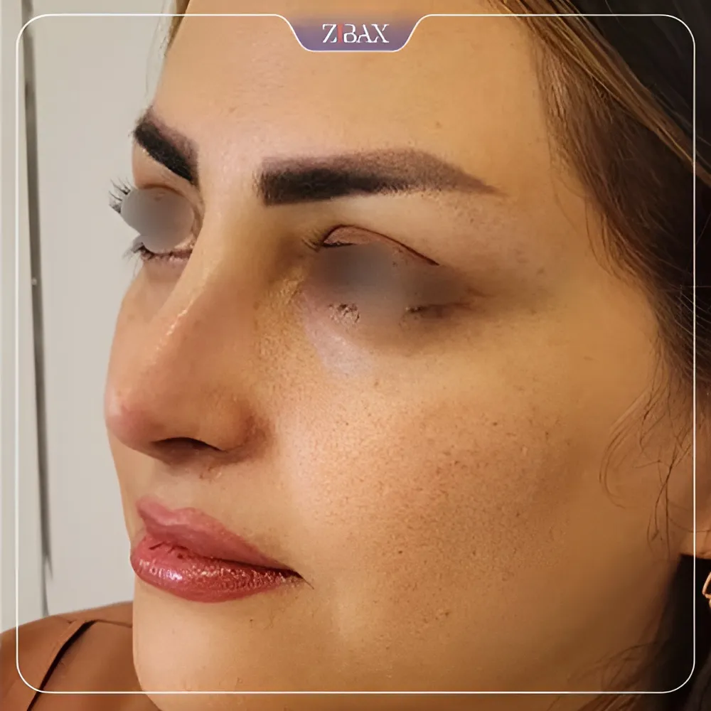 نمونه عمل جراحی بینی دکتر شمیلا رضوانی نیا — تصویر 9